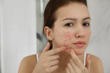 How Clinics in Islamabad Personalize Acne Scar Treatment Plans