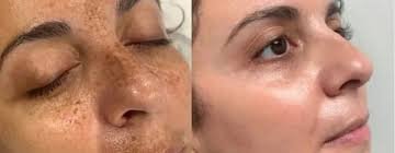 Achieve Radiant Skin with Pico Laser Treatment in Islamabad