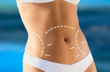 Tummy Tuck for Weight Loss Success Stories in Islamabad