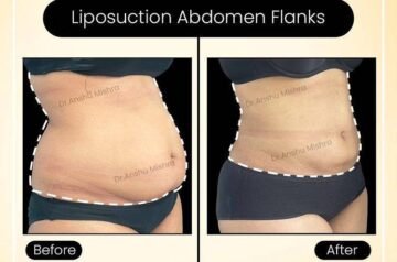 Liposuction Cost in Dubai | Liposuction Surgery in Dubai by Dr. Hans