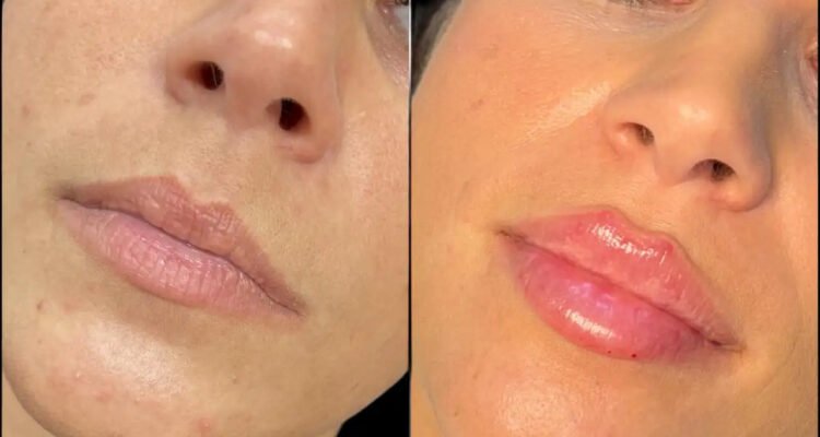 Best Doctors in Dubai for Fillers: Tailored Treatments for Every Face