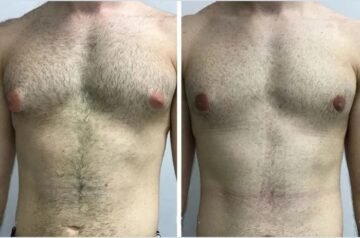 Gynecomastia in Dubai: Choosing Between Local and International Surgeons