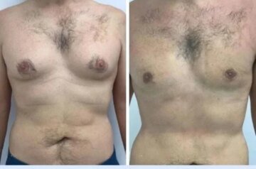 What Makes Dubai a Global Hub for the Best Gynecomastia Surgeons in dubai
