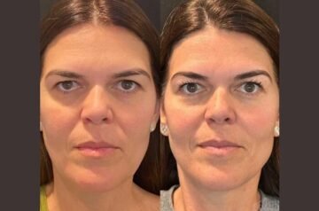 Achieve Smooth And Tightened Skin Using Thread Lift Treatments at Best Aesthetic Clinic in Dubai Today