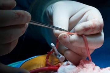 Top-Quality Cardiac Bypass Surgery in India with Expert Care from Indian Health Adviser