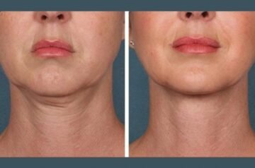 Best Doctors in Dubai PRP Treatment in Dubai for Natural Beauty Boost