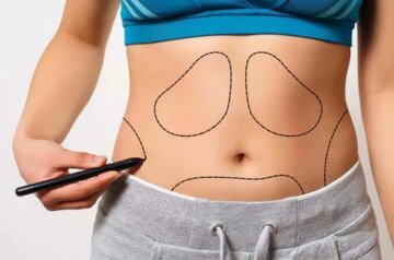 Liposuction in Islamabad: Safe Surgical Fat Removal