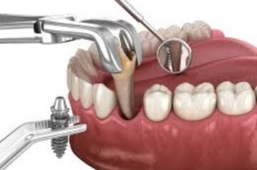 Dental Implants in Pune