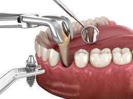 Premium Dental Implants in Pune
