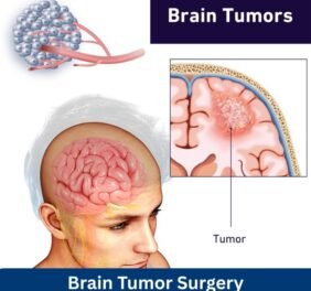 Affordable Brain Tum...