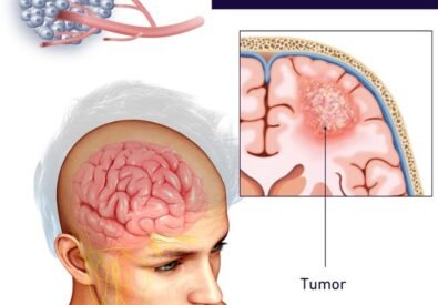 Affordable Brain Tum...