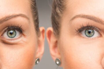 Eyelid Surgery in Islamabad: Restore Youthful Eyes with Confidence