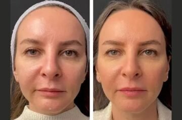 Best Aesthetic Clinics in dubai for Mesotherapy Treatment: Long-Lasting Effects